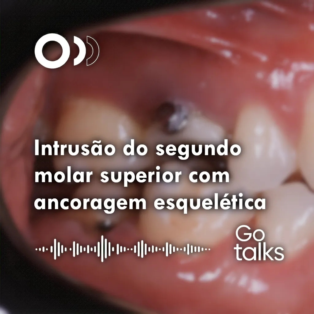 Intrusão do segundo molar superior com ancoragem esquelética