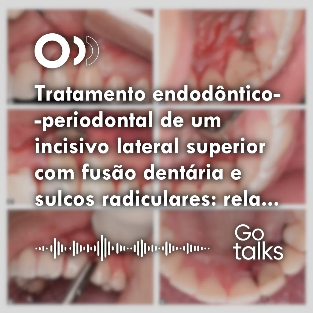 Tratamento endodôntico-periodontal de um incisivo lateral superior com fusão dentária e sulcos radiculares: relato de caso
