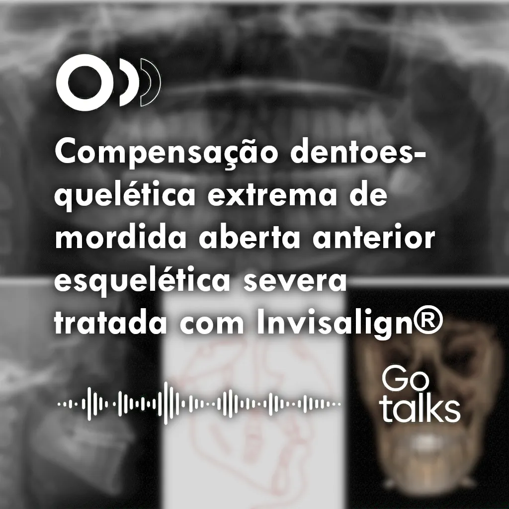 Compensação dentoesquelética extrema de mordida aberta anterior esquelética severa tratada com Invisalign®