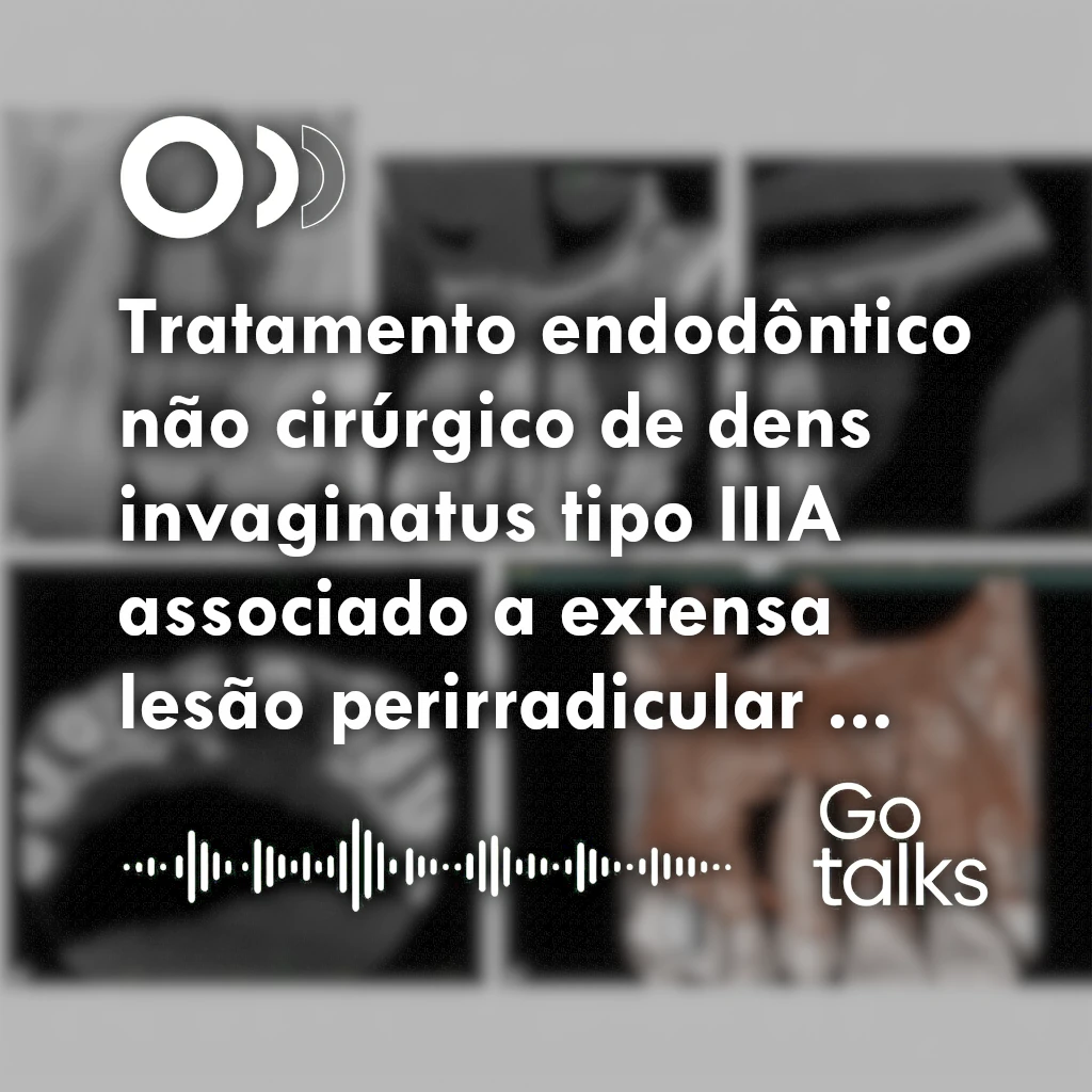 Tratamento endodôntico não cirúrgico de dens invaginatus tipo IIIA associado a extensa lesão perirradicular em paciente adolescente: relato de caso