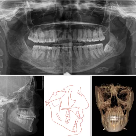 Compensação dentoesquelética extrema de mordida aberta anterior